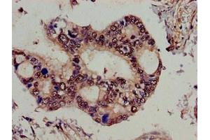 Immunohistochemistry of paraffin-embedded human pancreatic cancer using ABIN7159025 at dilution of 1:100 (SPG21 anticorps  (AA 1-308))