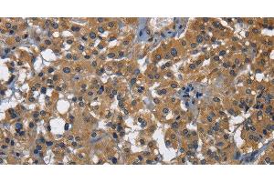 Immunohistochemistry of paraffin-embedded Human thyroid cancer using CD160 Polyclonal Antibody at dilution of 1:30 (CD160 anticorps)
