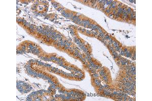 Immunohistochemistry of Human liver cancer using SIGLEC6 Polyclonal Antibody at dilution of 1:60 (SIGLEC6 anticorps)