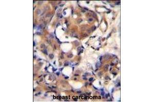 KNG1 Antibody (N-term) (ABIN655629 and ABIN2845108) immunohistochemistry analysis in formalin fixed and paraffin embedded human breast carcinoma followed by peroxidase conjugation of the secondary antibody and DAB staining.