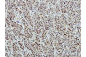 IHC-P Image Immunohistochemical analysis of paraffin-embedded MCF7 xenograft, using DDX56, antibody at 1:500 dilution. (DDX56 anticorps  (Center))