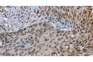 Immunohistochemistry of paraffin-embedded Human cervical cancer tissue using NMT1 Polyclonal Antibody at dilution 1:45 (NMT1 anticorps)