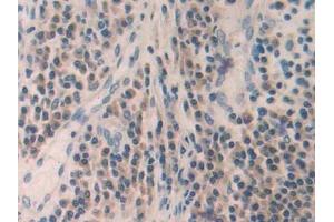 Detection of MMP24 in Human Skin cancer Tissue using Polyclonal Antibody to Matrix Metalloproteinase 24 (MMP24)