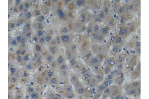 DAB staining on IHC-P; Samples: Human Liver cancer Tissue (Myosin IA anticorps  (AA 781-1043))