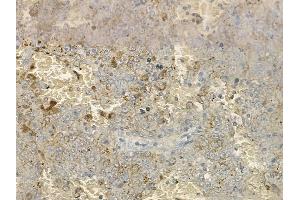 ABIN6264741 and ABIN6274043 at 1/100 staining human melanoma by IHC-P. (RhoA,B,C (C-Term) anticorps)