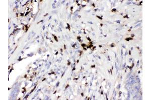 ORM1 was detected in paraffin-embedded sections of human intestinal cancer tissues using rabbit anti- ORM1 Antigen Affinity purified polyclonal antibody (Catalog # ) at 1 ?