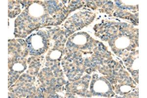 The image on the left is immunohistochemistry of paraffin-embedded Human thyroid cancer tissue using ABIN7128031(THAP2 Antibody) at dilution 1/20, on the right is treated with fusion protein. (THAP2 anticorps)