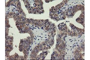 Immunohistochemical staining of paraffin-embedded Human prostate tissue using anti-PGM3 mouse monoclonal antibody.
