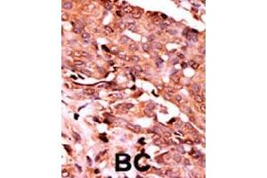 Formalin-fixed and paraffin-embedded human cancer tissue reacted with CASP6 (phospho S257) polyclonal antibody  which was peroxidase-conjugated to the secondary antibody followed by AEC staining. (Caspase 6 anticorps  (pSer257))