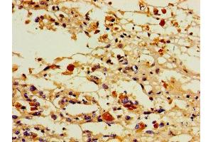 Immunohistochemistry of paraffin-embedded human melanoma using ABIN7164848 at dilution of 1:100