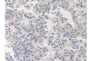 Detection of F8 in Human Prostate cancer Tissue using Polyclonal Antibody to Coagulation Factor VIII (F8)