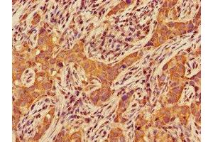 Immunohistochemistry of paraffin-embedded human pancreatic cancer using ABIN7147455 at dilution of 1:100 (CERK anticorps  (AA 212-478))