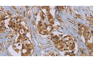 Immunohistochemistry of paraffin-embedded Human breast cancer using PUS10 Polyclonal Antibody at dilution of 1:45 (PUS10 anticorps)
