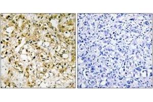 Immunohistochemistry analysis of paraffin-embedded human liver carcinoma tissue, using TFAM Antibody.