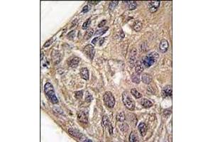 Formalin-fixed and paraffin-embedded human lung carcinoma tissue reacted with YARS antibody (C-term), which was peroxidase-conjugated to the secondary antibody, followed by DAB staining.