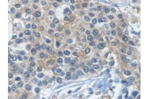 Detection of GAPDH in Human Prostate cancer Tissue using Monoclonal Antibody to Glyceraldehyde-3-Phosphate Dehydrogenase (GAPDH)