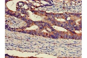 IHC image of ABIN7150697 diluted at 1:300 and staining in paraffin-embedded human colon cancer performed on a Leica BondTM system.