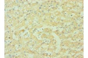 Immunohistochemistry of paraffin-embedded human liver cancer using ABIN7143440 at dilution of 1:100