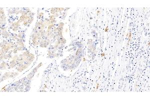 Detection of GYPA in Human Liver cancer Tissue using Polyclonal Antibody to Glycophorin A (GYPA) (CD235a/GYPA anticorps  (AA 20-91))
