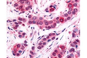 Anti-UCHL3 antibody IHC of human Breast, Carcinoma.