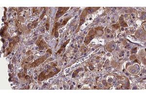 ABIN6277689 at 1/100 staining Human liver cancer tissue by IHC-P. (BMPR2 anticorps  (Internal Region))