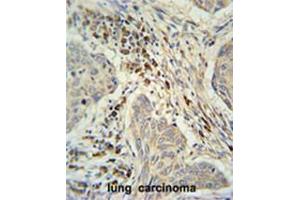 C19orf50 Antibody (Center) immunohistochemistry analysis in formalin fixed and paraffin embedded human lung carcinoma followed by peroxidase conjugation of the secondary antibody and DAB staining. (C19orf50 anticorps  (Middle Region))