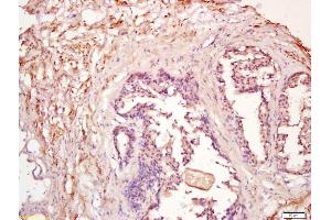 Formalin-fixed and paraffin embedded human prostate labeled with Anti-PDGF-D Polyclonal Antibody, Unconjugated (ABIN714581) at 1:200 followed by conjugation to the secondary antibody and DAB staining (PDGFD anticorps  (AA 271-370))