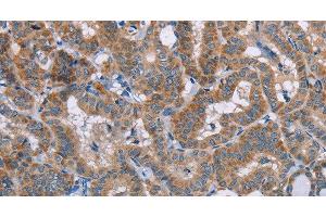 Immunohistochemistry of paraffin-embedded Human thyroid cancer using POMT1 Polyclonal Antibody at dilution of 1:50 (POMT1 anticorps)