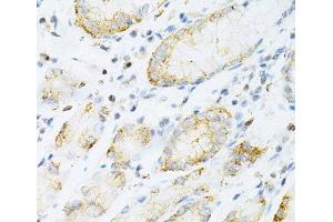 Immunohistochemistry of paraffin-embedded Human gastric cancer using SULT2A1 Polyclonal Antibody at dilution of 1:200 (40x lens).