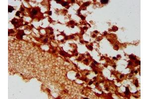 IHC image of ABIN7163270 diluted at 1:400 and staining in paraffin-embedded human melanoma performed on a Leica BondTM system. (PACS2 anticorps  (AA 268-465))