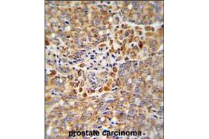 Formalin-fixed and paraffin-embedded human prostate carcinoma reacted with ALKBH3 Antibody , which was peroxidase-conjugated to the secondary antibody, followed by DAB staining.