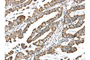 The image on the left is immunohistochemistry of paraffin-embedded Human esophagus cancer tissue using ABIN7191329(LTB4R2 Antibody) at dilution 1/20, on the right is treated with synthetic peptide. (LTB4R2 anticorps)
