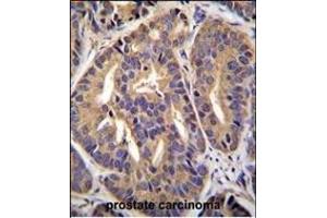 GTF2H2C Antibody (C-term) (ABIN655372 and ABIN2844928) immunohistochemistry analysis in formalin fixed and paraffin embedded human prostate carcinoma followed by peroxidase conjugation of the secondary antibody and DAB staining. (GTF2H2C anticorps  (C-Term))