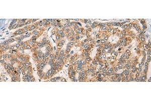 Immunohistochemistry of paraffin-embedded Human liver cancer tissue using NLGN1 Polyclonal Antibody at dilution of 1:50(x200) (Neuroligin 1 anticorps)