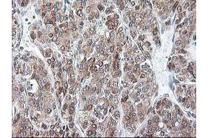 Immunohistochemical staining of paraffin-embedded Carcinoma of Human liver tissue using anti-RPN1 mouse monoclonal antibody. (RPN1 anticorps)