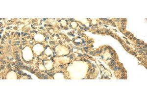 Immunohistochemistry of paraffin-embedded Human thyroid cancer using SDHA Polyclonal Antibody at dilution of 1/40 (SDHA anticorps)