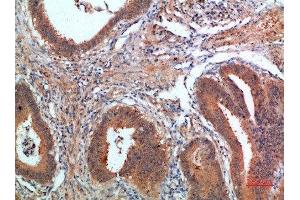 Immunohistochemical analysis of paraffin-embedded human-colon-cancer, antibody was diluted at 1:200 (PDGFC anticorps  (AA 61-110))