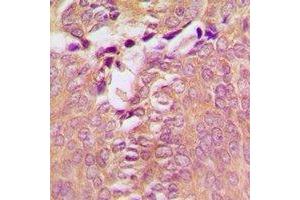 Immunohistochemical analysis of DAP Kinase 1 staining in human breast cancer formalin fixed paraffin embedded tissue section.
