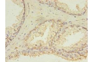 Immunohistochemistry of paraffin-embedded human prostate cancer using ABIN7154764 at dilution of 1:100 (HDDC3 anticorps  (AA 2-140))