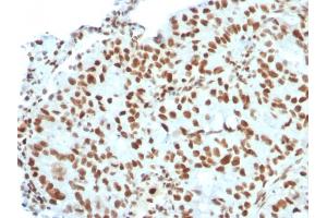 Formalin-fixed, paraffin-embedded human Breast Carcinoma stained with BMI1 Mouse Monoclonal Antibody (BMI1/2823).