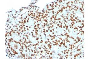 Formalin-fixed, paraffin-embedded human Breast Carcinoma stained with BMI1 Mouse Monoclonal Antibody (BMI1/2823). (BMI1 anticorps  (AA 142-326))