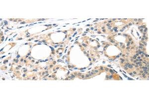Immunohistochemistry of paraffin-embedded Human thyroid cancer tissue using MASP2 Polyclonal Antibody at dilution 1:35 (MASP2 anticorps)