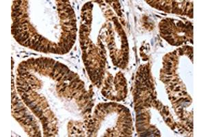 The image on the left is immunohistochemistry of paraffin-embedded Human colon cancer tissue using ABIN7193127(Map2 Antibody) at dilution 1/40, on the right is treated with synthetic peptide. (MAP2 anticorps)
