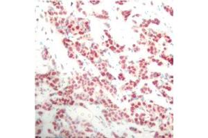 Immunohistochemistry of paraffin-embedded human breast carcinoma using Phospho-NFKB2-S866 antibody (ABIN2988214). (NFKB2 anticorps  (pSer866))