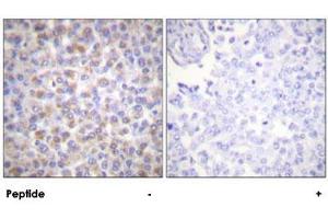 Immunohistochemical analysis of paraffin-embedded human breast carcinoma tissue using YWHAZ polyclonal antibody . (14-3-3 zeta anticorps)