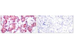 Immunohistochemical analysis of paraffin-embedded human breast carcinoma tissue using GATA-1 (phospho-Ser142) antibody (E011041). (GATA1 anticorps  (pSer142))