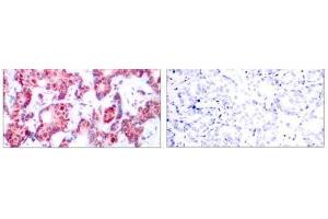 Immunohistochemical analysis of paraffin-embedded human breast carcinoma tissue using GATA-1 (phospho-Ser142) antibody (E011041). (GATA1 anticorps  (pSer142))