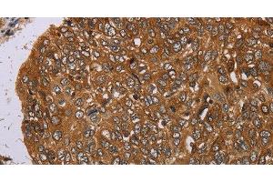 Immunohistochemistry of paraffin-embedded Human esophagus cancer tissue using PIM3 Polyclonal Antibody at dilution 1:35 (PIM3 anticorps)