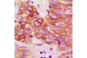 Immunohistochemical analysis of Calmodulin (pT80/S82) staining in human breast cancer formalin fixed paraffin embedded tissue section.