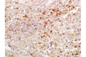 Formalin-fixed and paraffin embedded human lung carcinoma labeled with Rabbit Anti AKR1A1 Polyclonal Antibody, Unconjugated (ABIN872733) at 1:200 followed by conjugation to the secondary antibody and DAB staining (AKR1A1 anticorps  (AA 53-130))